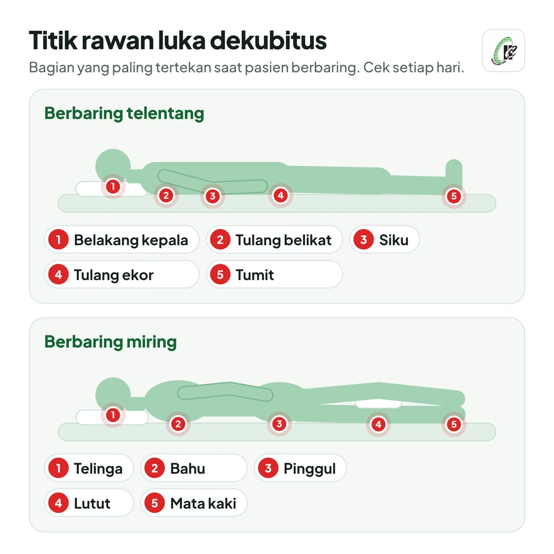 Gambar titik rawan luka dekubitus. Saat berbaring telentang: belakang kepala, tulang belikat, siku, tulang ekor, dan tumit. Saat berbaring miring: telinga, bahu, pinggul, lutut, dan mata kaki.